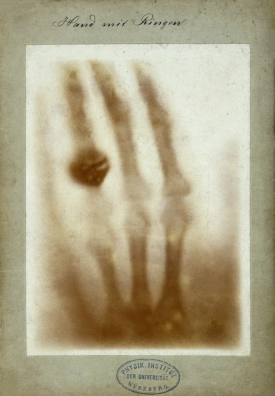 Première radiographie médicale historique de la main de Bertha Röntgen